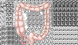 appendicitis_0.gif appendicitis_0.gif